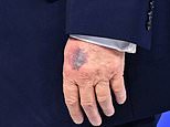 Trump describes excruciating moment that resulted in severe bruise on hand… as he teases FOURTH term Trump describes excruciating moment that resulted in severe bruise on hand… as he teases FOURTH term