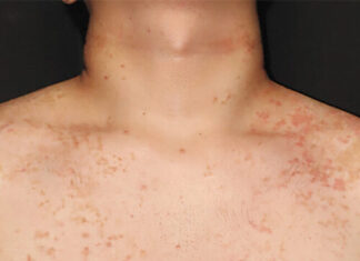 A weird, itchy rash is linked to the keto diet—but no one knows why A weird, itchy rash is linked to the keto diet—but no one knows why