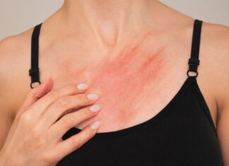 A real head scratcher: how scabies returned to the UK A real head scratcher: how scabies returned to the UK