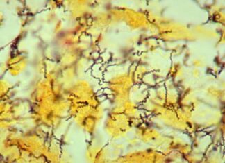 Cea mai veche dovadă a sifilisului a fost descoperită într-un schelet de 5.500 de ani din Columbia Cea mai veche dovadă a sifilisului a fost descoperită într-un schelet de 5.500 de ani din Columbia