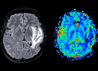 Obesity and high blood pressure may directly cause dementia Obesity and high blood pressure may directly cause dementia