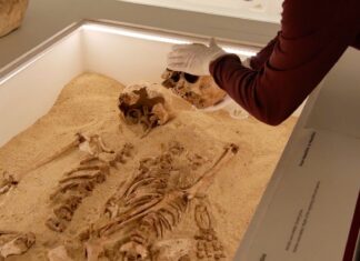 Skeletons reveal Stone Age mother and daughter had a rare genetic condition Skeletons reveal Stone Age mother and daughter had a rare genetic condition