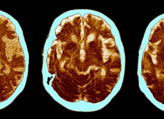 The curious link between Alzheimer’s disease and cancer The curious link between Alzheimer’s disease and cancer
