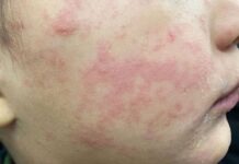 Experts call for a measles ‘immunization action plan’ in Ontario Experts call for a measles ‘immunization action plan’ in Ontario