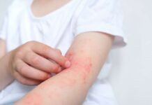 Vous n’allez pas en revenir : ces allergies improbables existent bel et bien Vous n’allez pas en revenir : ces allergies improbables existent bel et bien